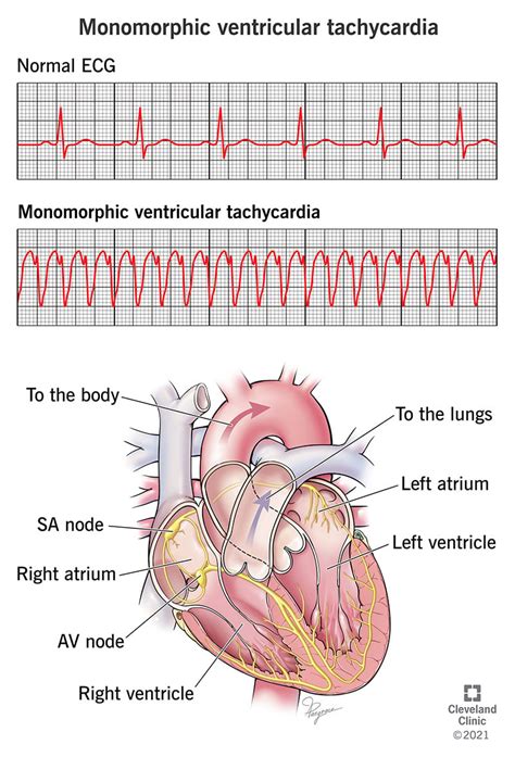 vt medical abbreviation.